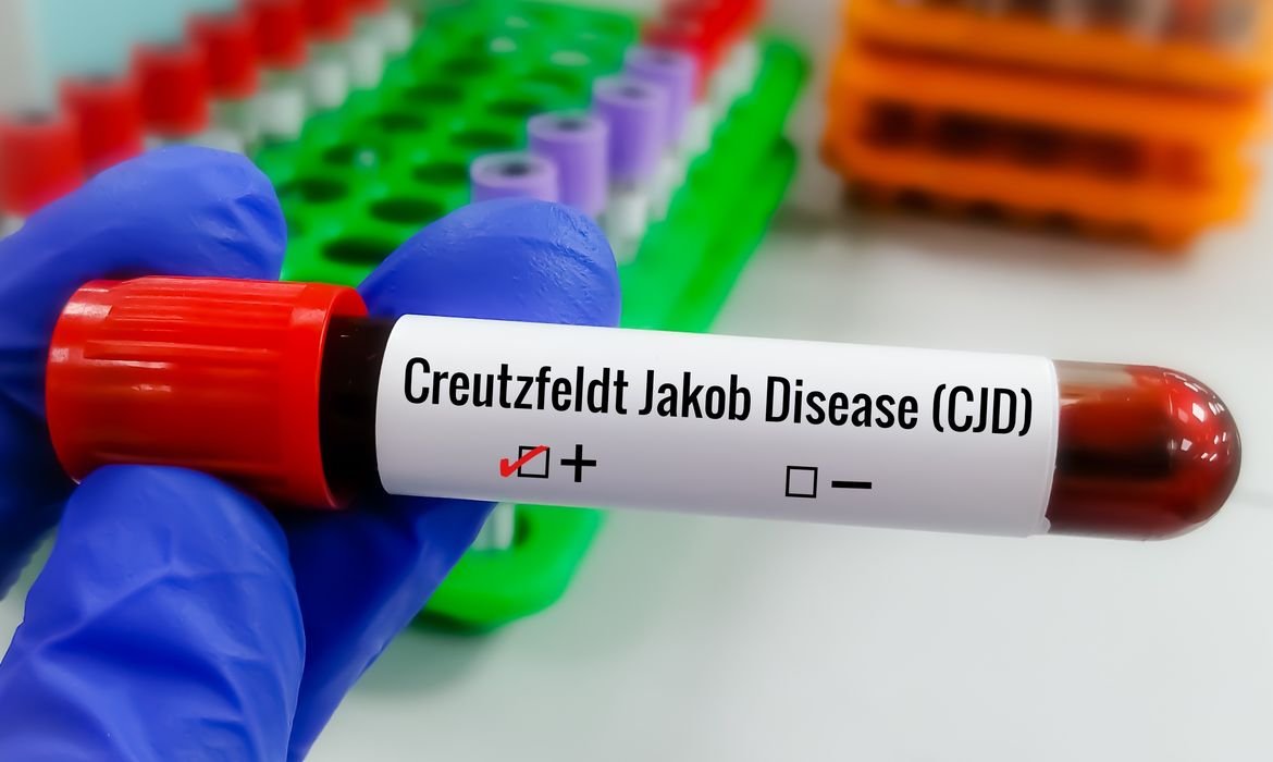 Creutzfeldt-Jakob: doença rara e rápida