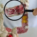 Doenças inflamatórias intestinais disparam no Brasil