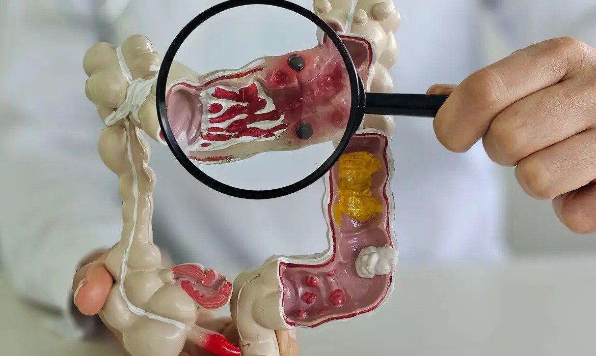 Doenças inflamatórias intestinais disparam no Brasil