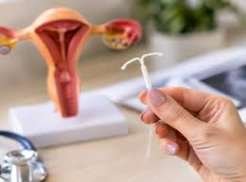 Planos devem custear DIU hormonal e inserção para pacientes com endometriose